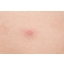 90988-good-bye-blemish-clear-patch-after.jpg