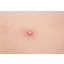 90988-good-bye-blemish-clear-patch-before.jpg